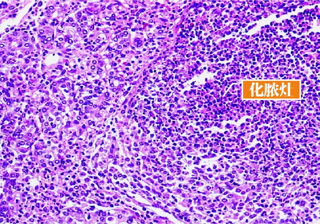 12.1-1 急性唾液腺炎.jpg