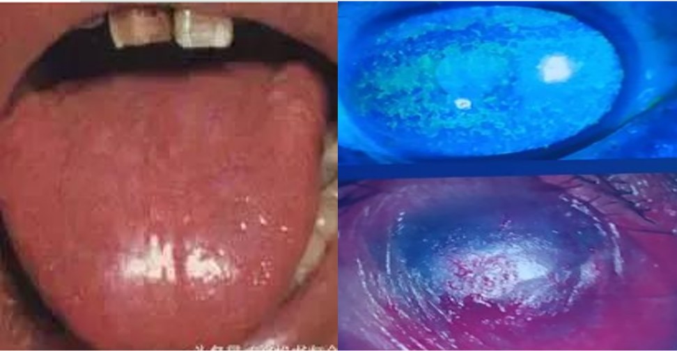 12.1-7 镜面舌 角膜干燥.jpg