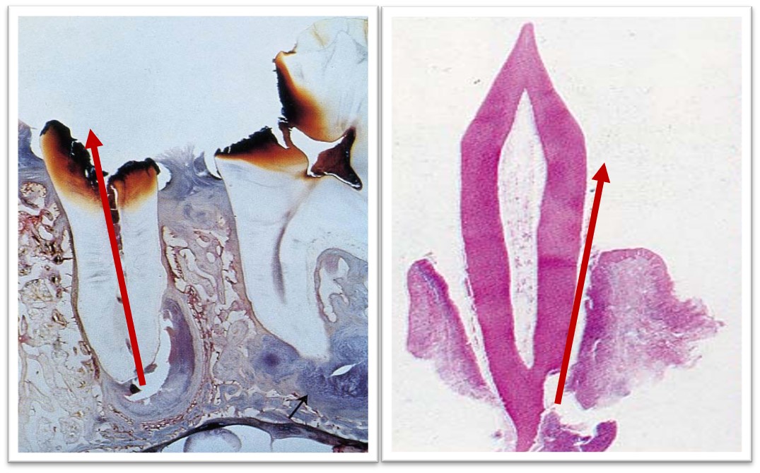9.1-5 脓液引流途径2.jpg