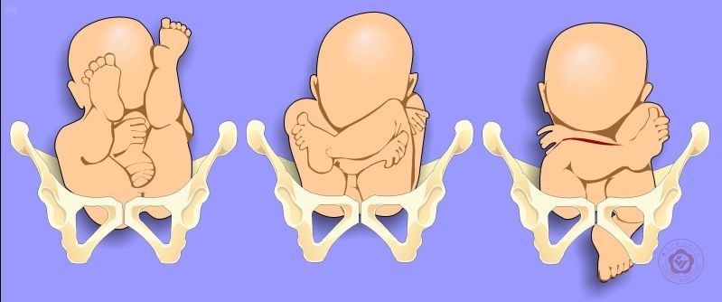 臀先露的分类