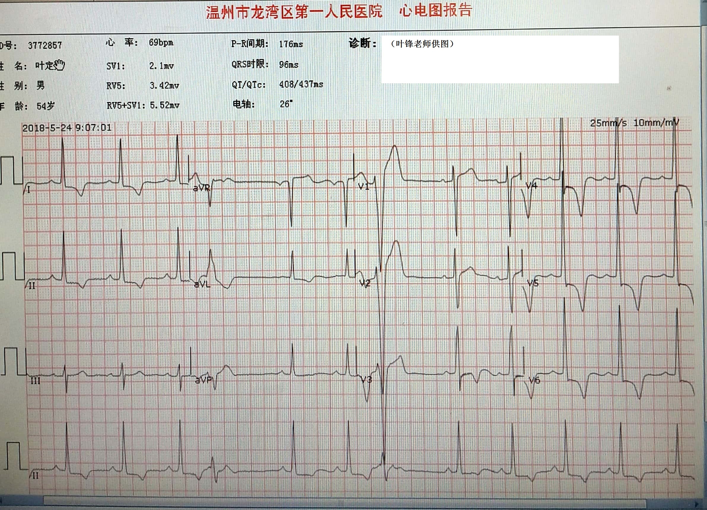 心尖肥厚型心肌病可能,需要心脏超声佐证 d.  心室预激 答案
