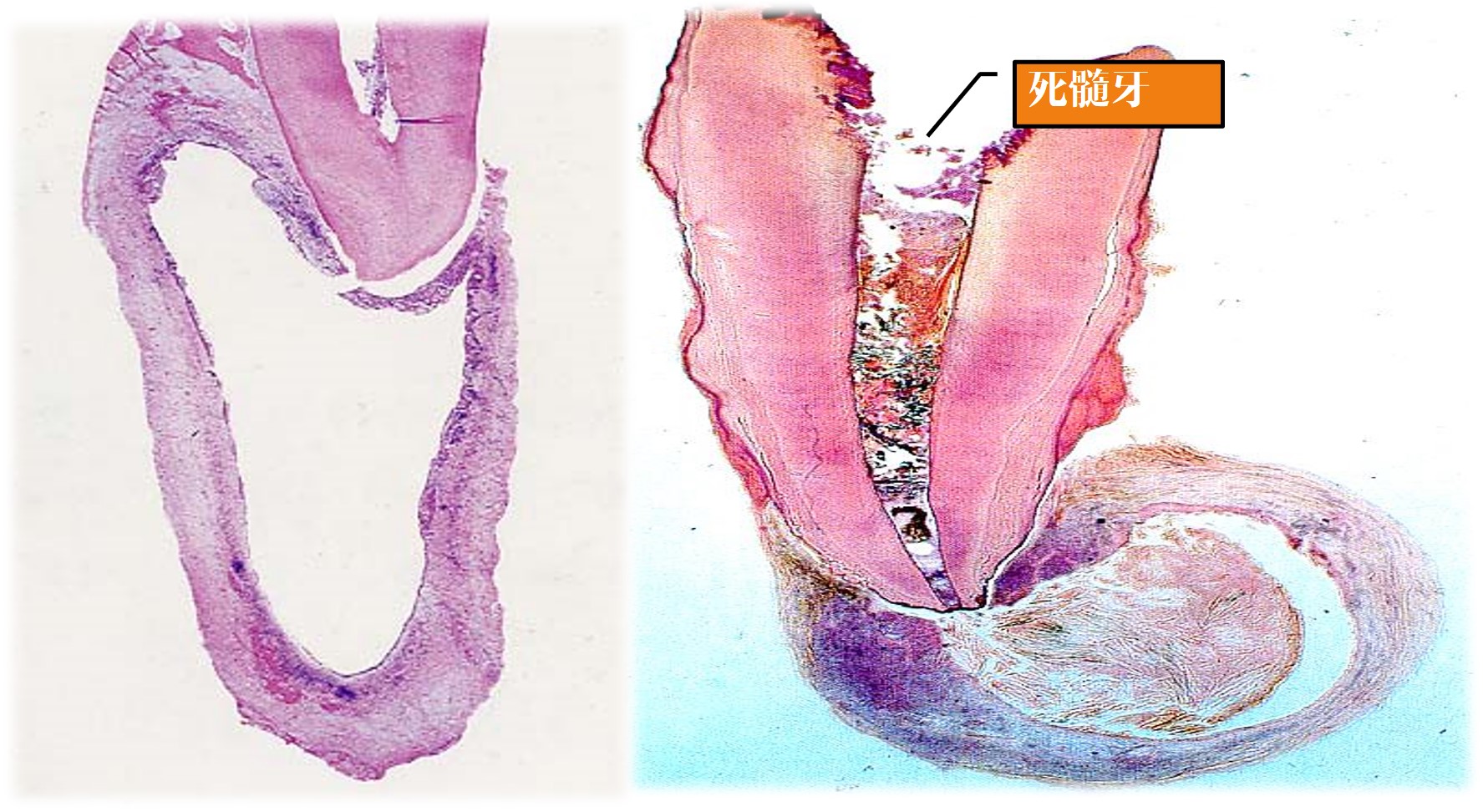 13.1-14 根尖周囊肿(光镜).jpg
