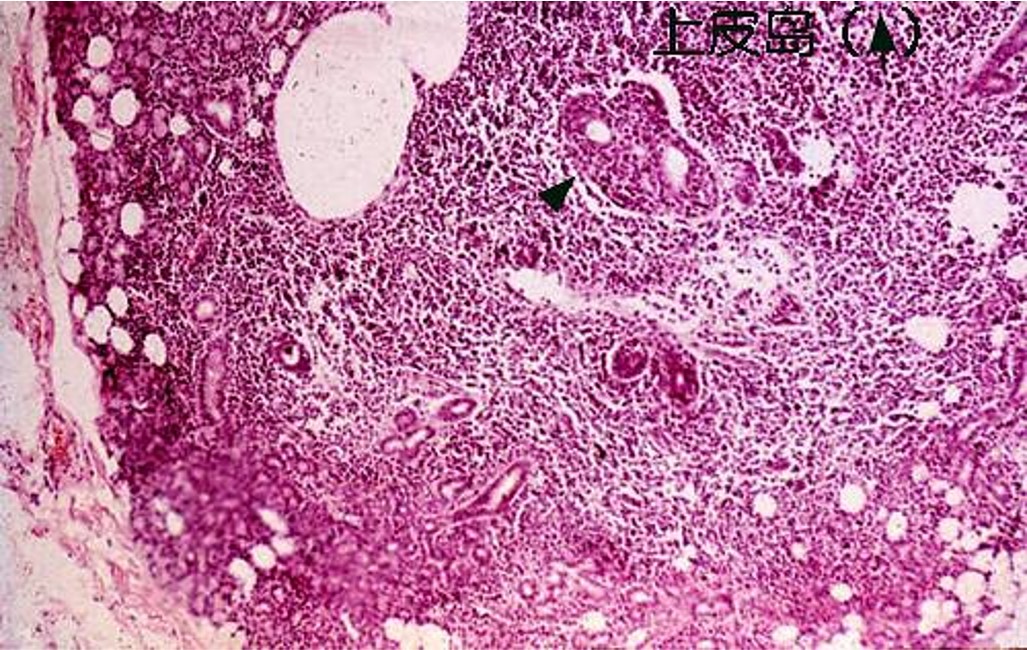 12.1-10 舍格伦综合征(最终).jpg
