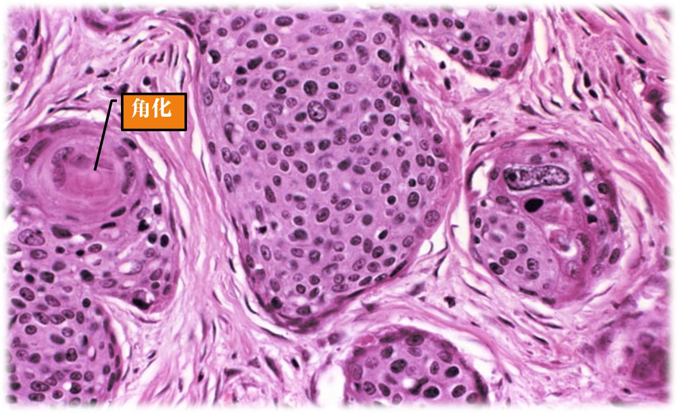 15.1-8 基底细胞鳞状细胞癌.jpg