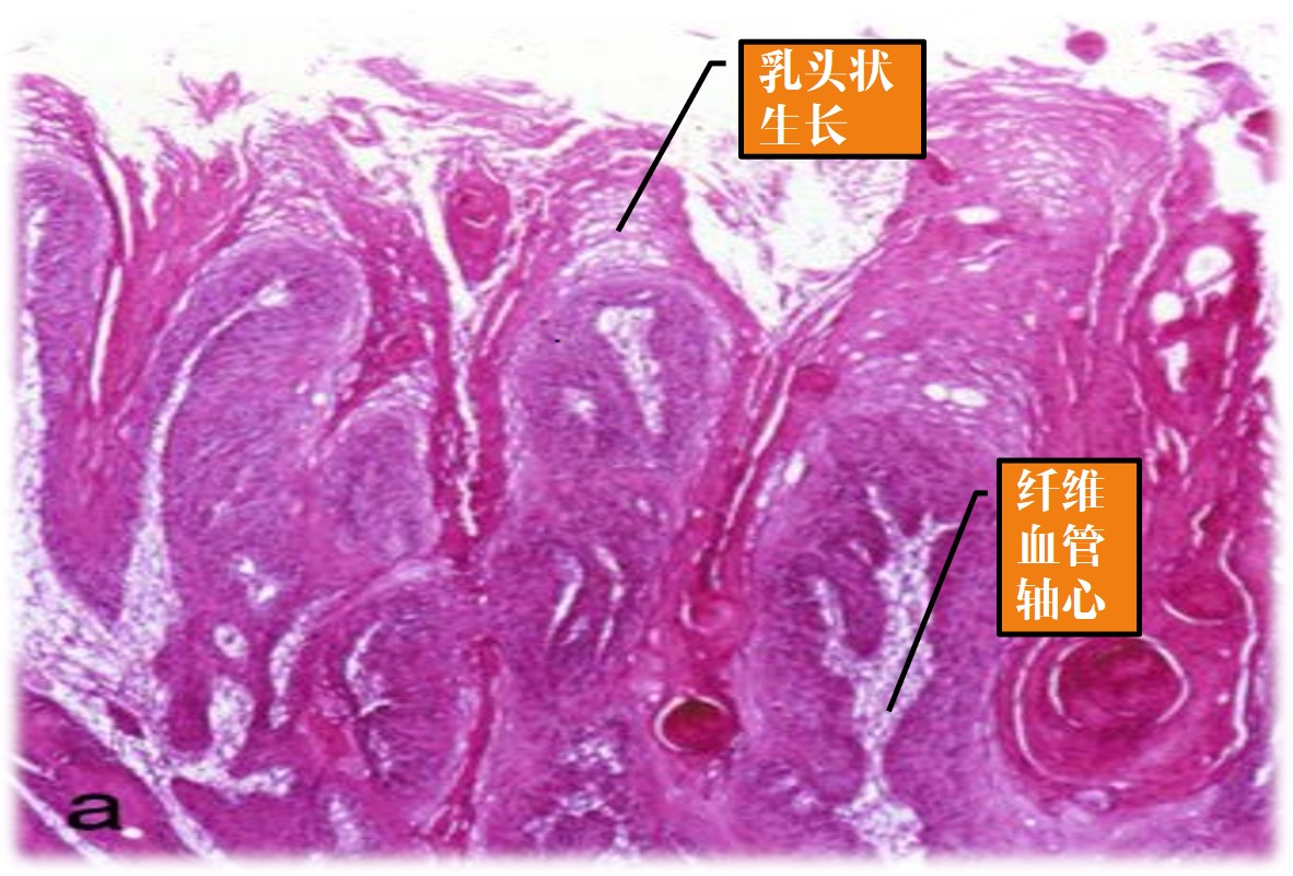 15.1-9 乳头状鳞状细胞癌.jpg