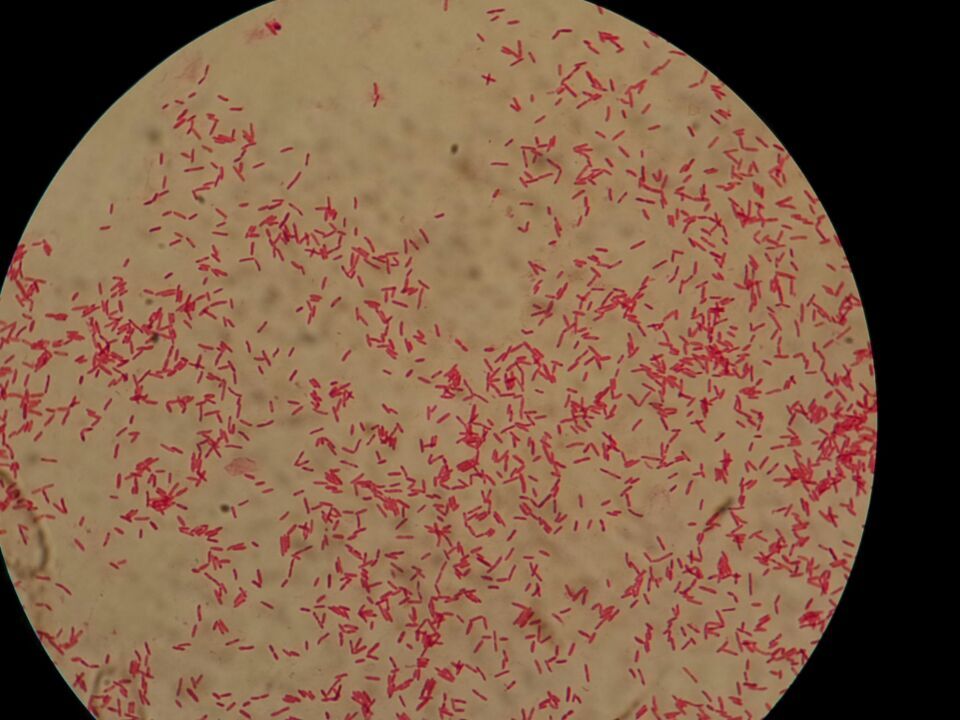结核分枝杆菌检验中用革兰染色常不着色,有人称之为"鬼影",如下图片