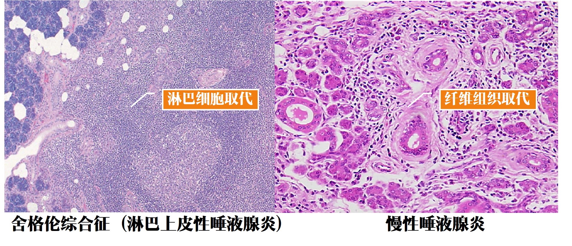 12.1-12 舍格伦综合征与慢性唾液腺炎.jpg
