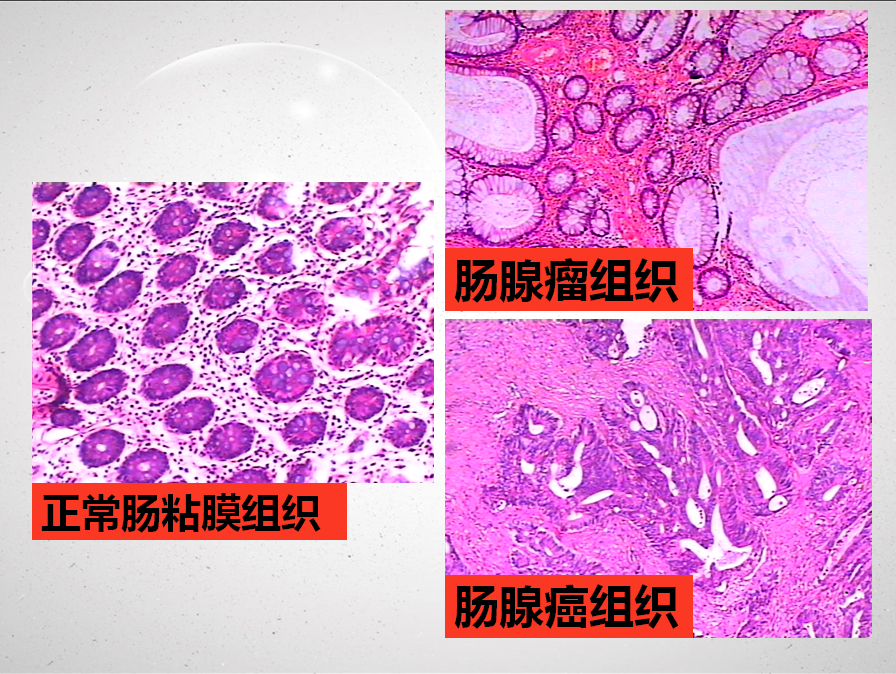 正常肠粘膜,肠腺瘤,肠腺癌除细胞形态差异外,还表现在