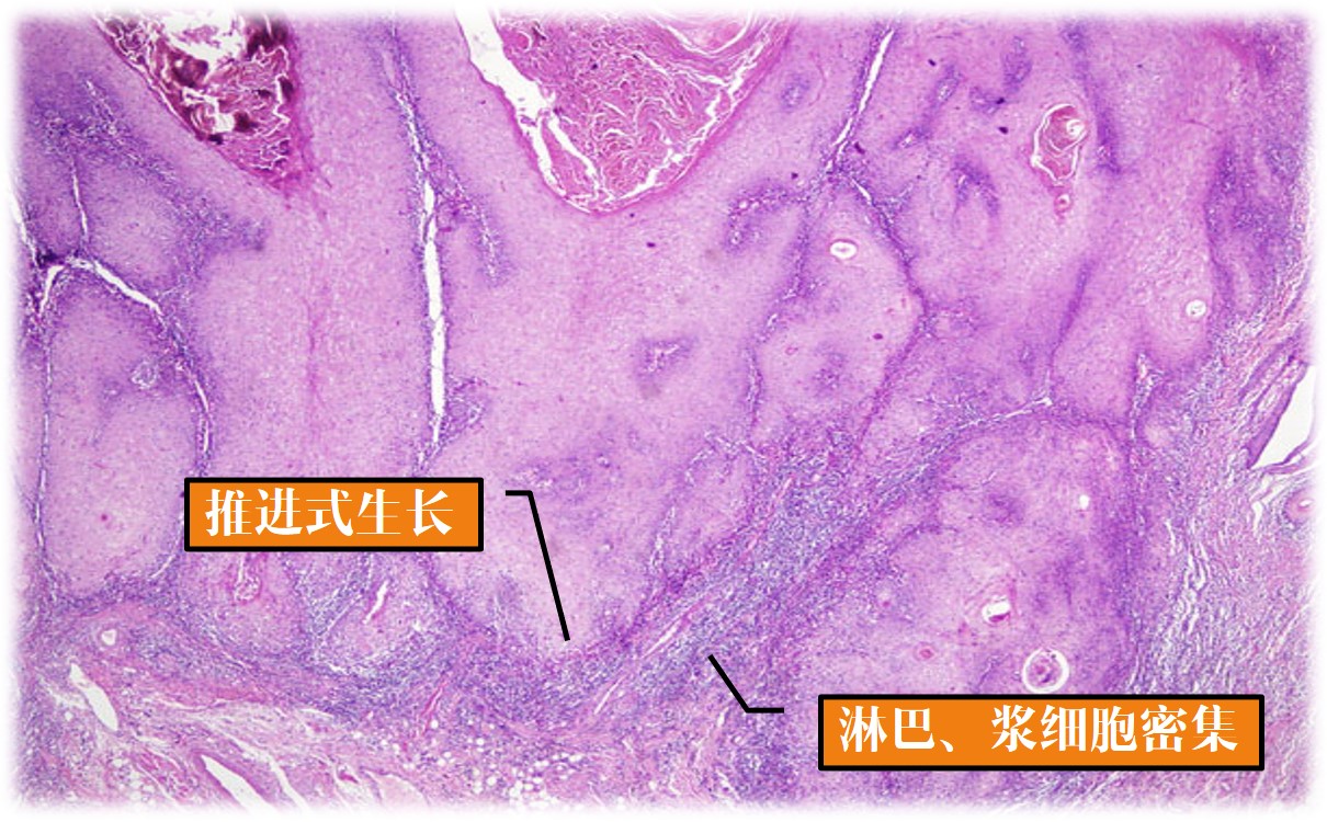 15.1-7 疣状癌.jpg