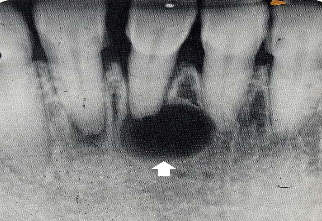 13.1-13 根尖周囊肿(X线).jpg