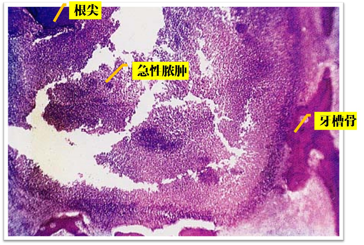 9.1-3 急性化脓性根尖周炎.jpg