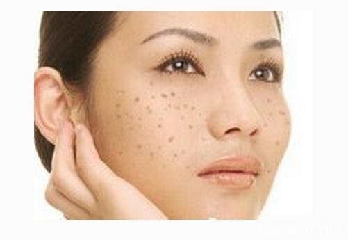 黄褐斑。7.jpg