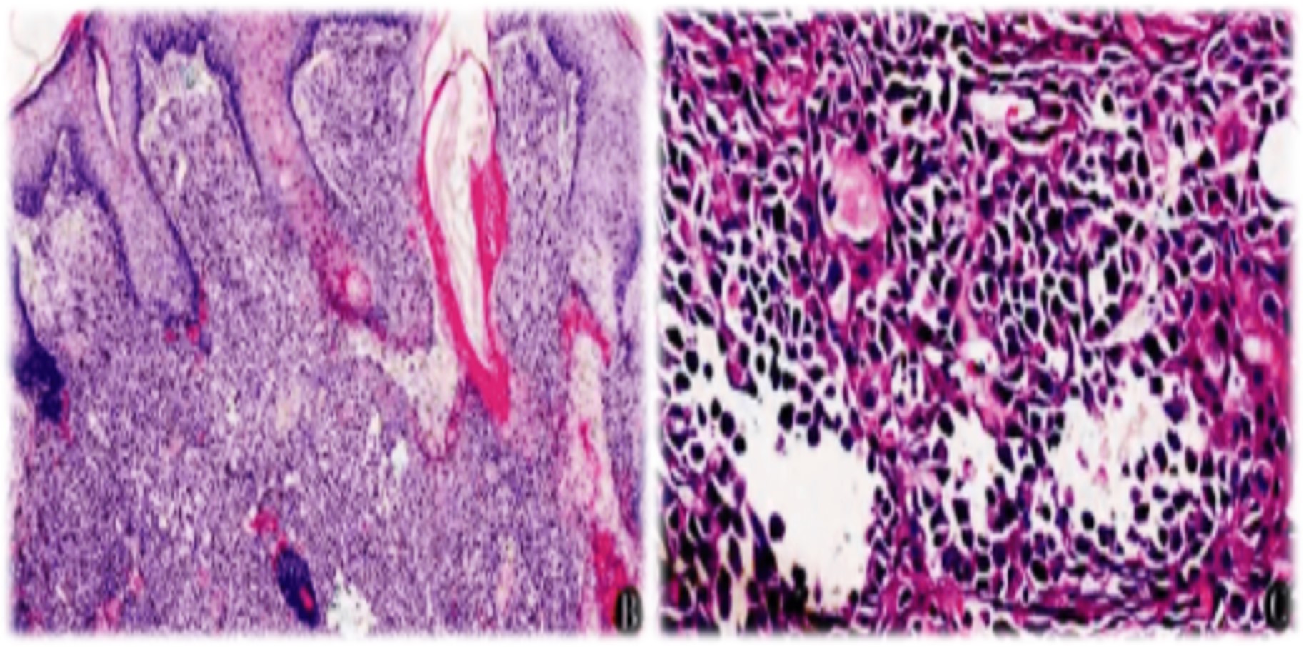 15.1-11 棘层松解性鳞状细胞癌.jpg