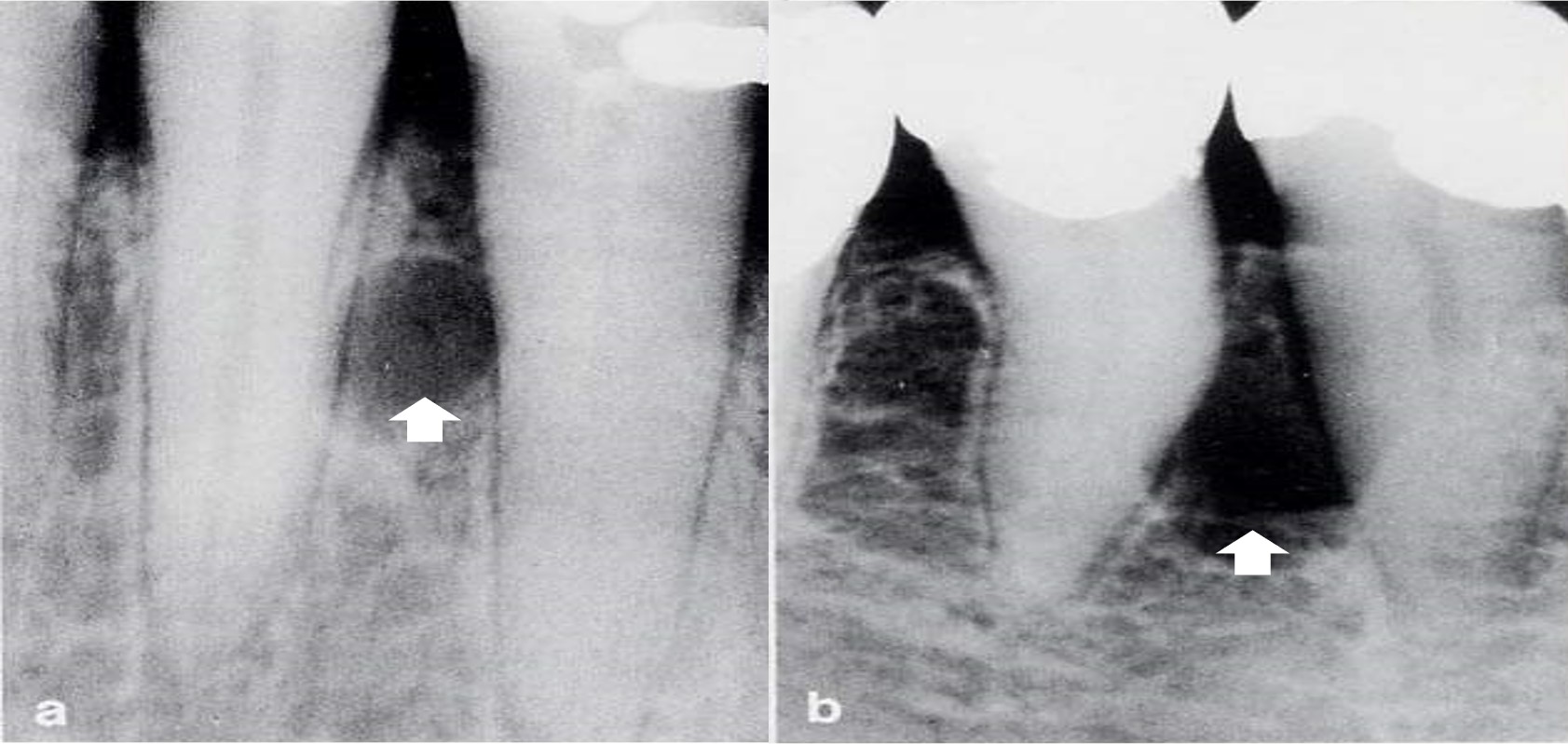 13.1-7 发育性根侧囊肿(X线).jpg