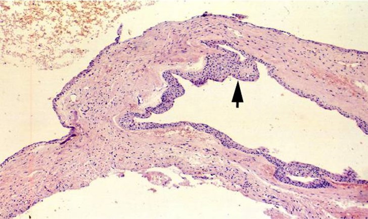 13.1-8 发育性根侧囊肿(上皮斑).jpg