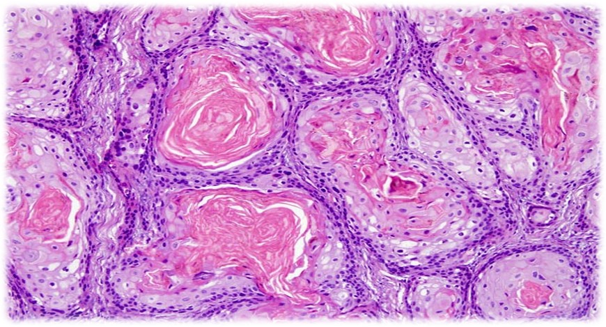 15.1-4 高分化鳞状细胞癌.jpg