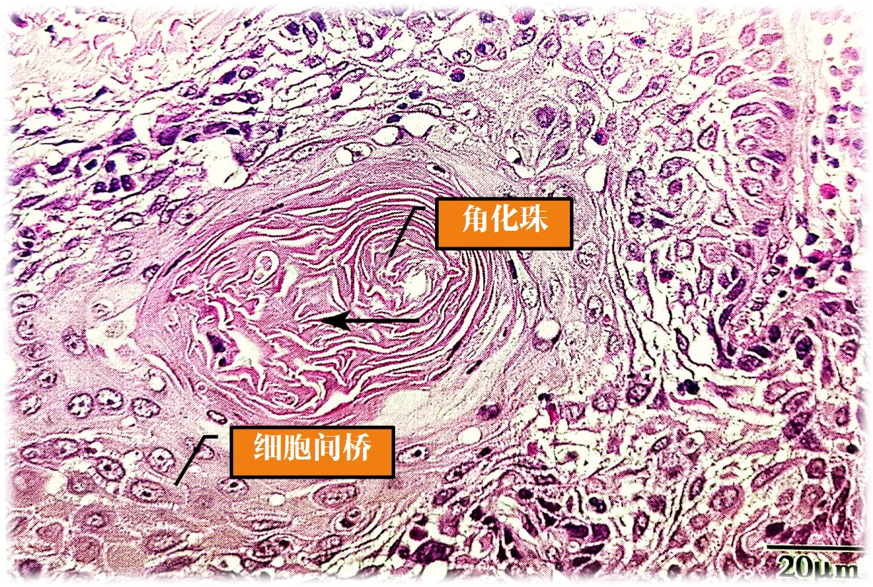 15.1-3 鳞状细胞癌(角化珠和细胞间桥).jpg