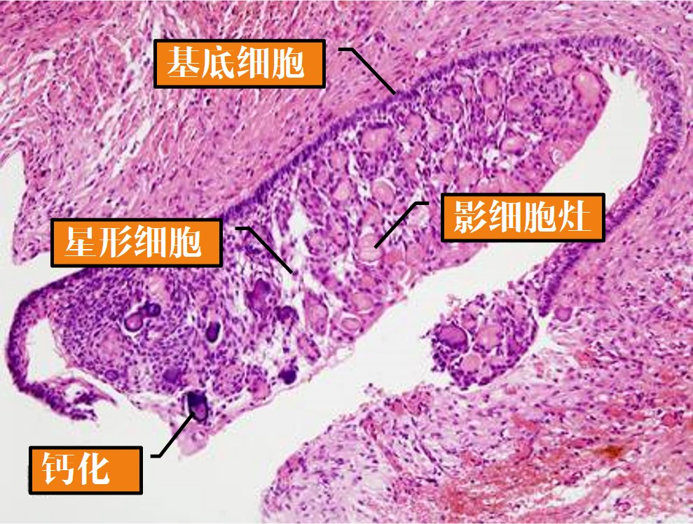 13.1-11 牙源性钙化囊肿(光镜).jpg