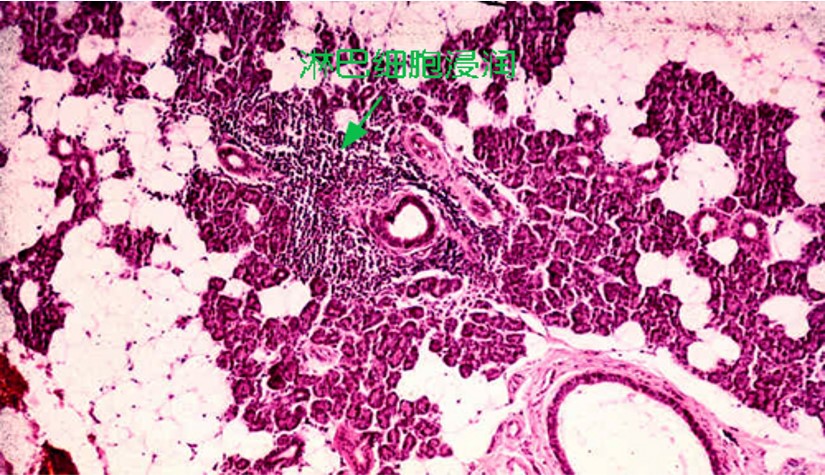 12.1-8 舍格伦综合征(最初).jpg