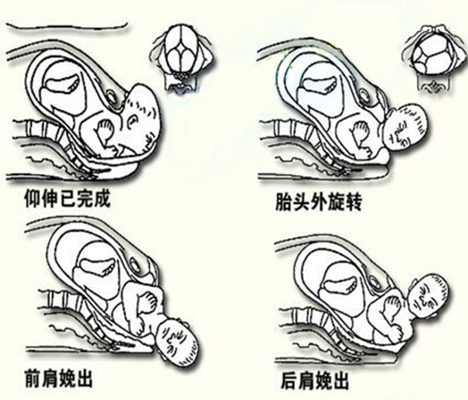 分娩机制(mechanism of labor):是指胎儿先露部在通过产道时,为适应