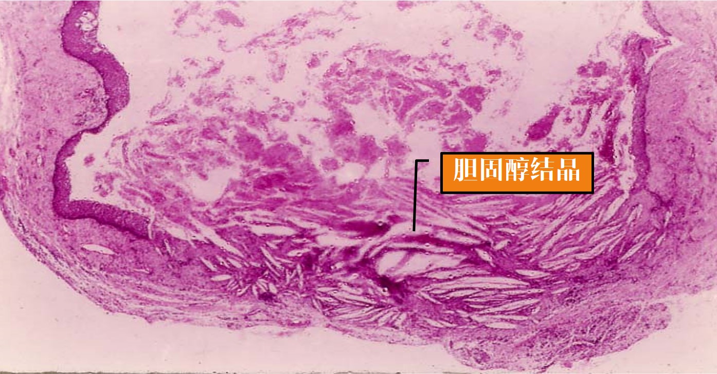 13.1-15 根尖周囊肿(胆固醇结晶).jpg