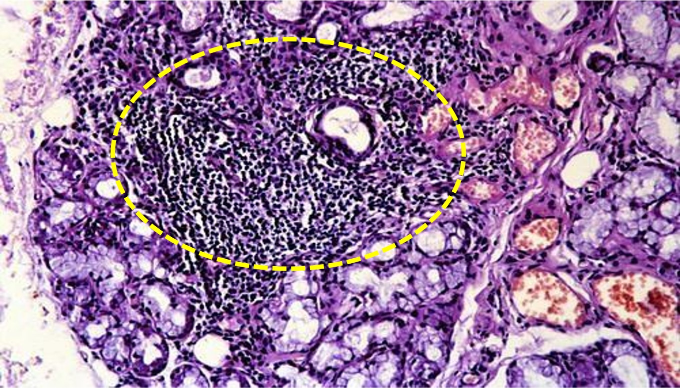 12.1-13 唇腺活检.jpg