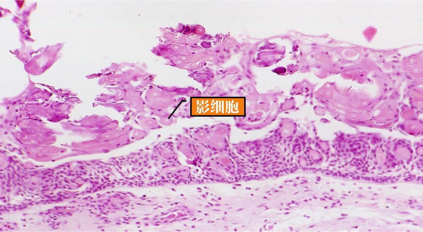 13.1-12 牙源性钙化囊肿(影细胞).jpg