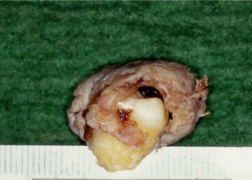 13.1-2 含牙囊肿(肉眼).jpg