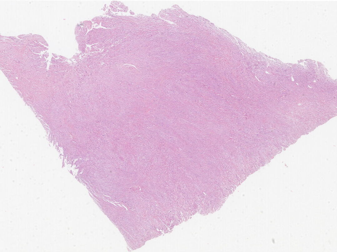 14_纤维肉瘤(3)_kfb_0.7173293X.jpg