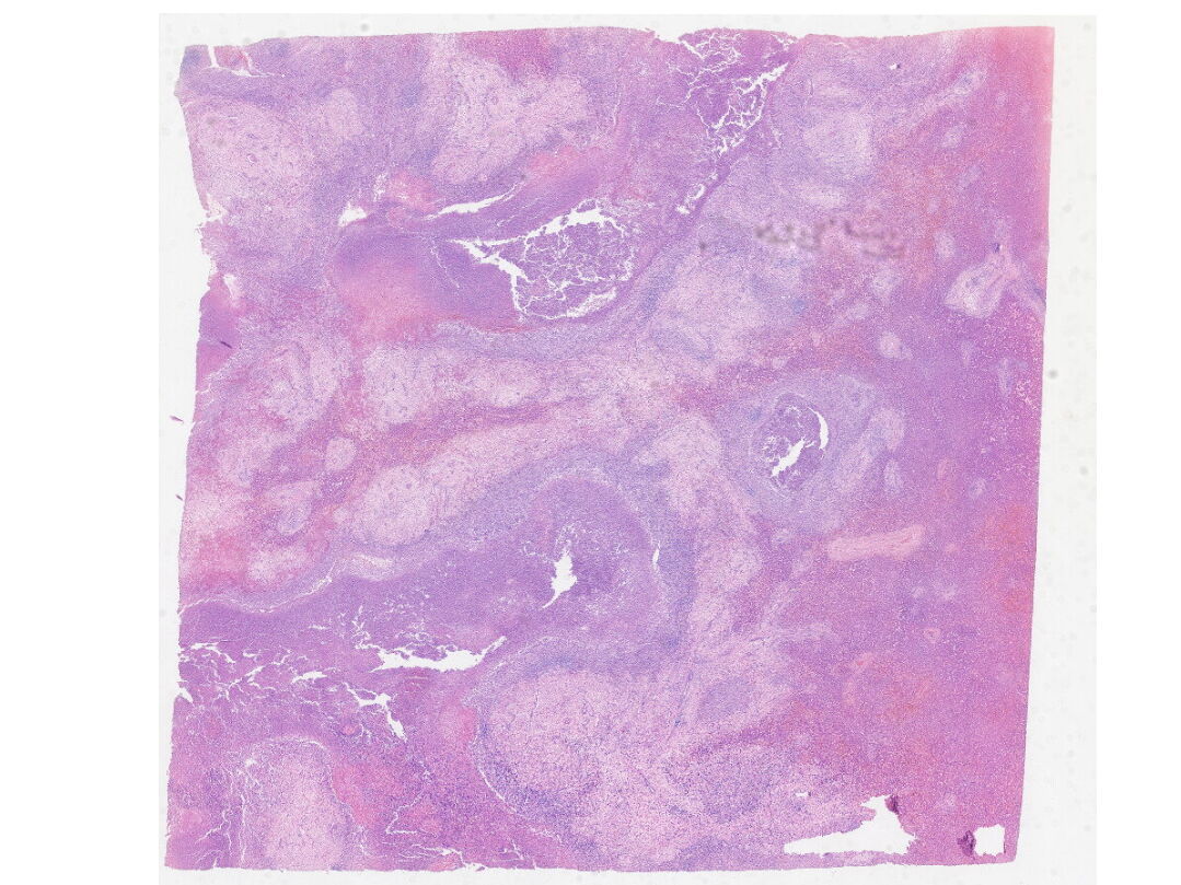 9_肝脓肿_kfb_0.5640545X.jpg