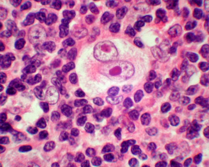 4-18-3 霍奇金淋巴瘤(10×40).jpg