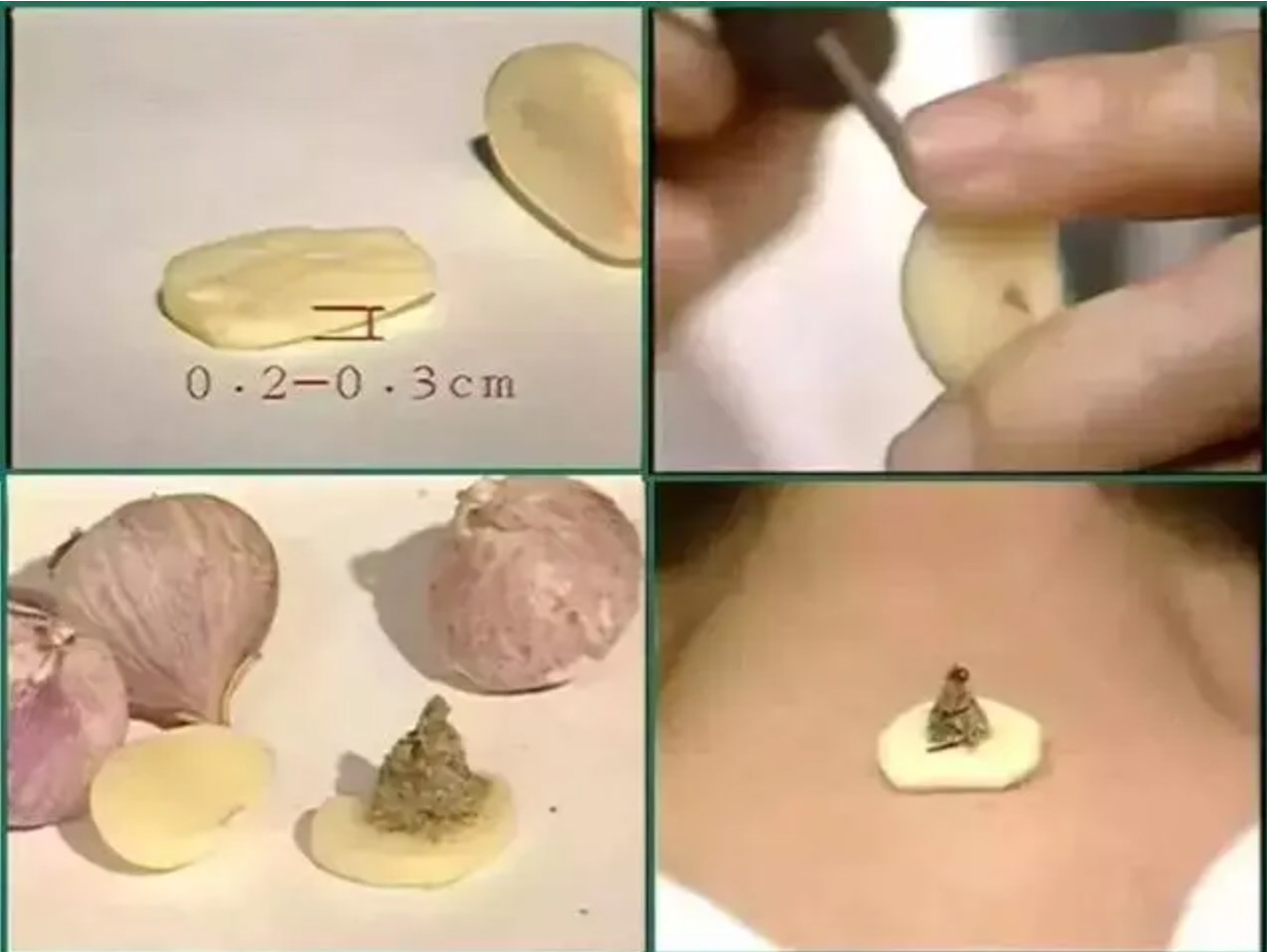 隔蒜灸演示-独头蒜