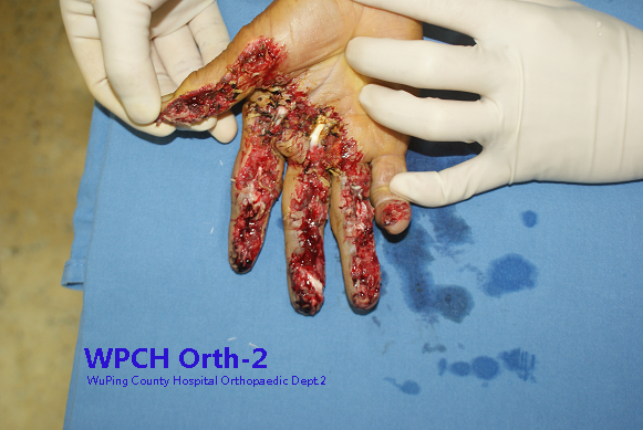 这也是一个老年病例,主动废弃损伤最严重的手指,指动脉皮瓣修复邻近