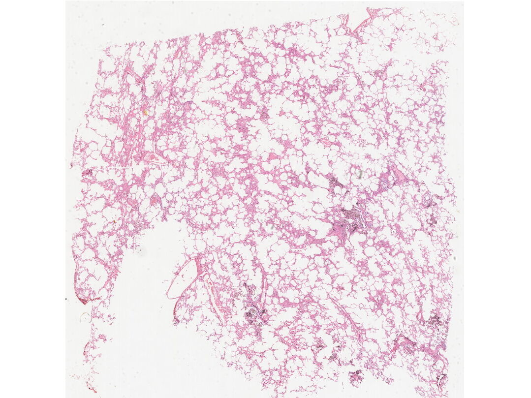 5_肺淤血水肿 (1)_kfb_0.5X.jpg