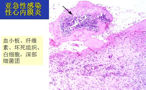 亚急性感染性心内膜炎.jpg