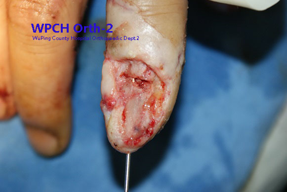 微型腹壁皮瓣修复手指软组织缺损
