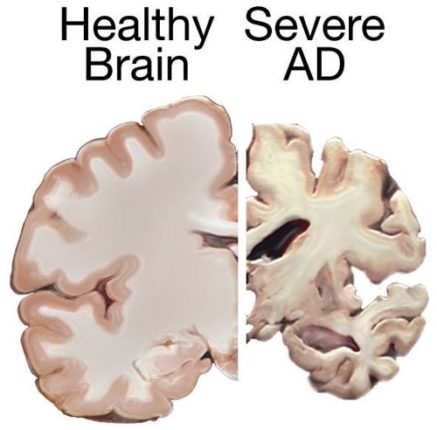 Alzheimers_brain-437x430.jpg